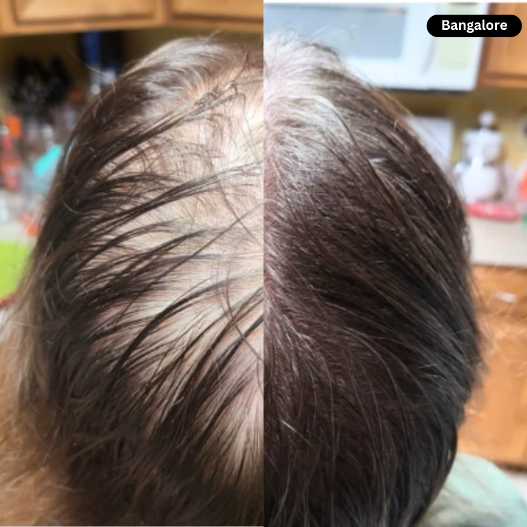 🔥 Advanced Clinical-Grade Red Light Hair Regrowth Therapy Cap
